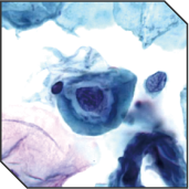 ASCUS